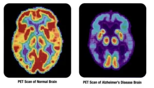 alzheimers-disease